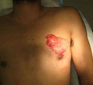 gyno (male breast) surgery Gynecomastia Surgery Cost