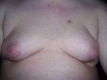 Boobs with Obesity in Male Causes of Man Boob