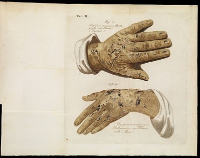 Skin Disorder and Pellagra Pellagra Symptoms